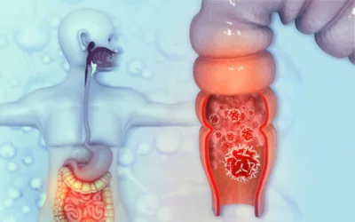 Colorectal Cancer Screening & Treatment