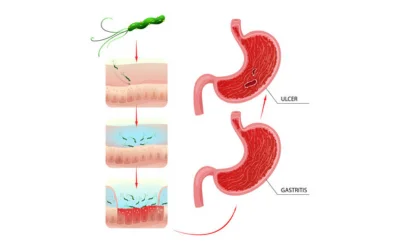 Gastritis and Peptic Ulcers